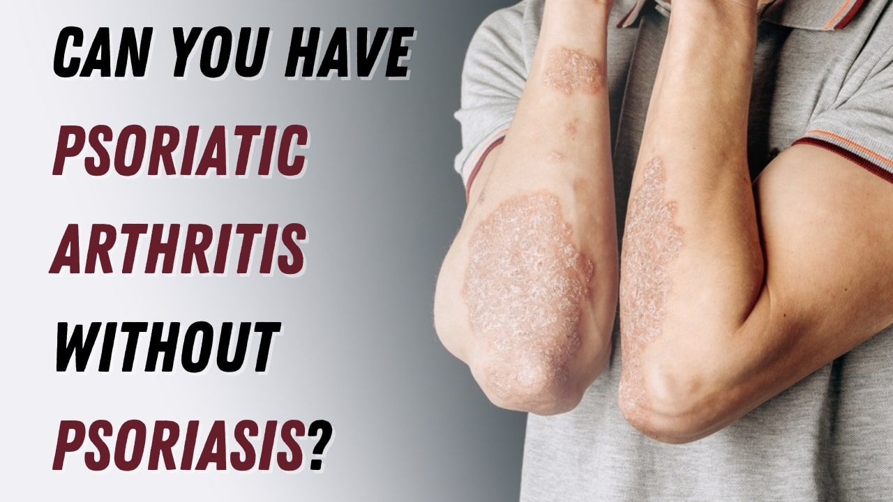 Can You Have Psoriatic Arthritis Without Psoriasis?